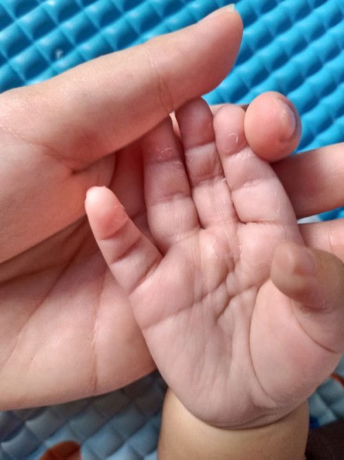 Telapak tangan mengelupas