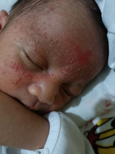 MGA MOMMY ANO PO KAYA ANG GAMOT SA GANITONG RASHES NG BABY NAAAWA AKO SA BABY KO MAY RASHES SA MUKHA