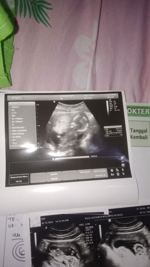 Assalamu'alaikum bunda , aku hamil 16minggu dan dari awal hamil sampe sekarang keluar darah seger