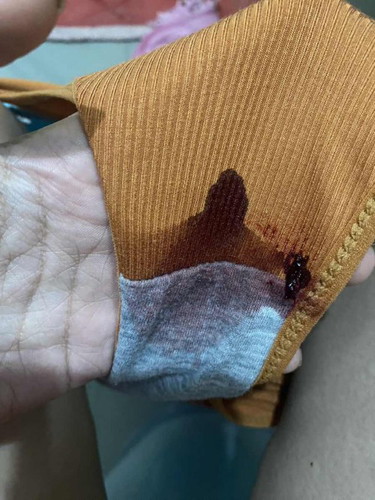 BLEEDING PREGNANT