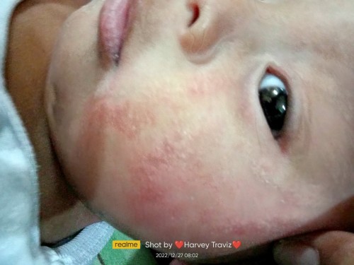 Ano po pwede ipahid po sa face nG baby ko?
