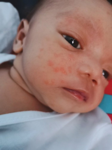 Baby Acne ni Baby