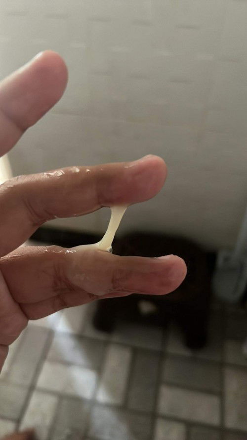 ขออภัยรูปในภาพด้วยนะคะ ยังงี้คือมูกใสป่าวค่ะ นัดผ่าวันที่2 ม.ค.
ต้องทำยังไงค่ะ หรือเราต้องไปหาหมอ คุณแม่คนไหนรู้ช่วยบอกหน่อยค่ะ