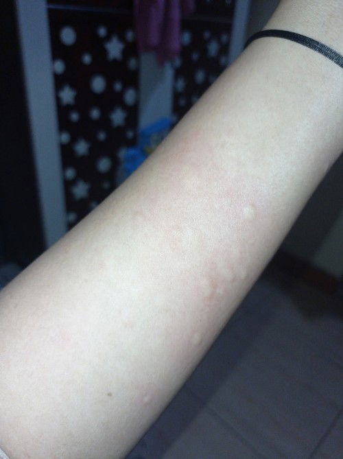 Gatal yang berpindah