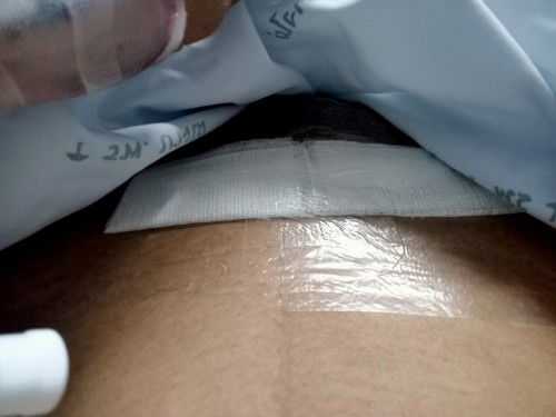 แท้งและผ่าช็อกโกแลตซีสต์