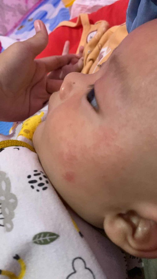 Bunda” bayiku umur 4bln di wajahnya penuh ruam merah gitu, trs gatel digaruk” trs sm anakku.