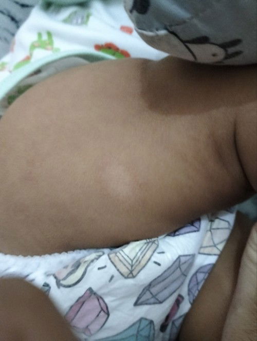 Kulit kering pada bayi