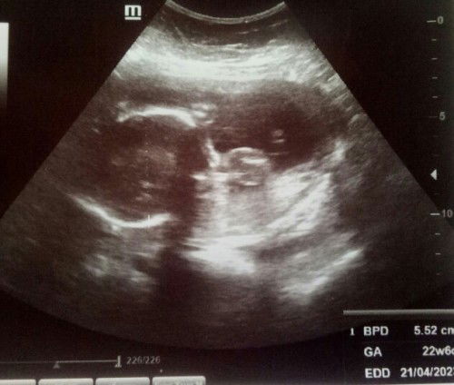 Bingung baca hasil USG nya