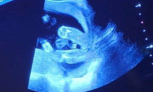 Boy or girl ya? Doctor kata girl. Huu