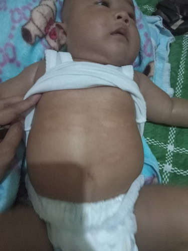 Bun mau tanya ini kulit bagian perut anak ku seperti luka ,kira2 cara mengatasinya gmna yah