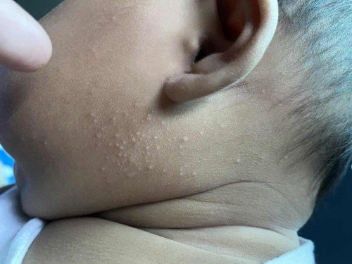 ผื่นขึ้นตัวตาเด็ก