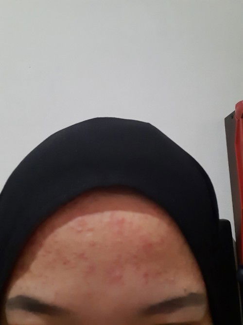 Tips Ilangin Jerawat Dan Bekas nya bund