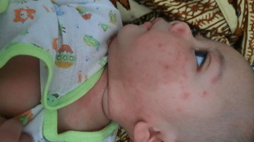 GATAL GATAL AREA MUKA