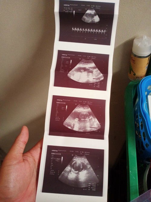 สอบถามแม่ๆคะ ตอนนี้ได้22w ไปซาวมาหมอบอกน้องหัวอยู่ข้างล่าง แม่ๆว่าได้ ลูกหญิงหรือชายคะ