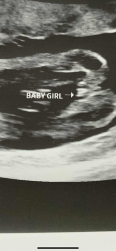 20 weeks pregnant