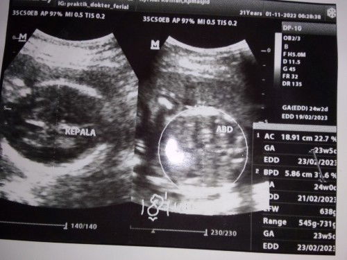 Hasil USG pas 31-32week mksd yang aku garis merahin itu apa ya Bun? Soalnya lupa nanya saama doktern