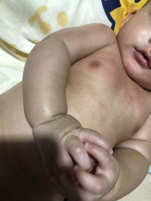 ตรวจภูมิแพ้ในเด็ก