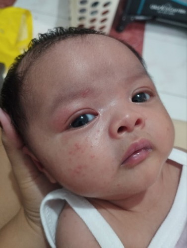 Rashes sa cheeks ni baby