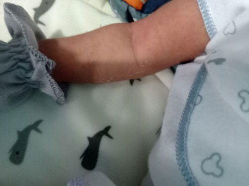 Tangan dan kaki bruntusan merah