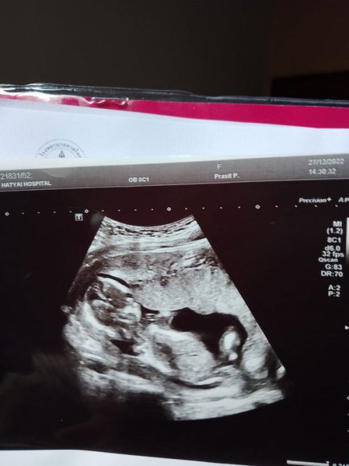 แม่ๆรุ้เพศเบบี๋ตอนกี่วีคคะ