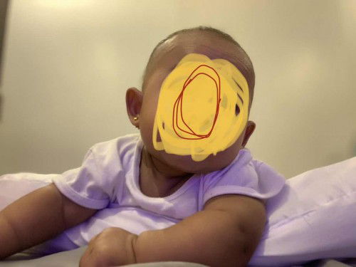 Tabingi ang leeg ni baby