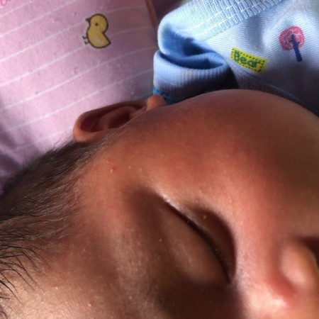 น้องโดนบิบแถวแก้มเป็นร้อยบุ๋ม