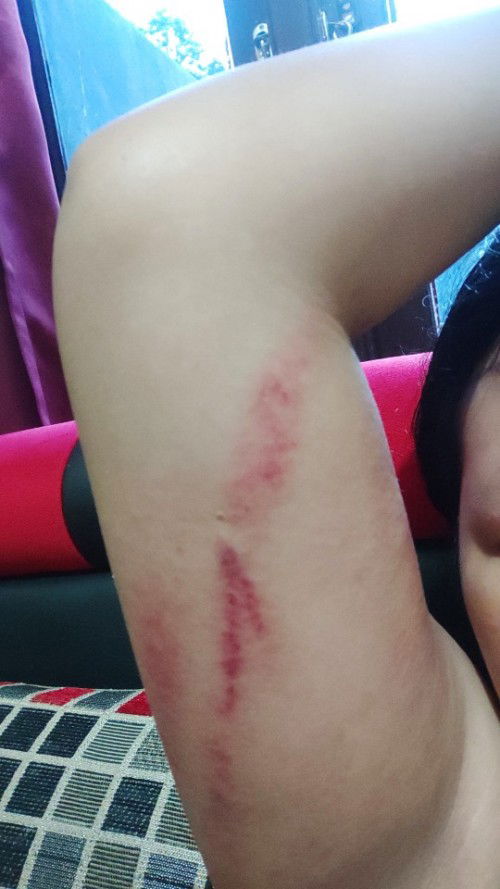 Implan ga sengaja ke kerik