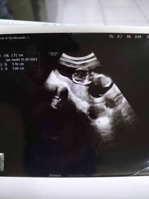 Hasil USG berbeda dengan hpht