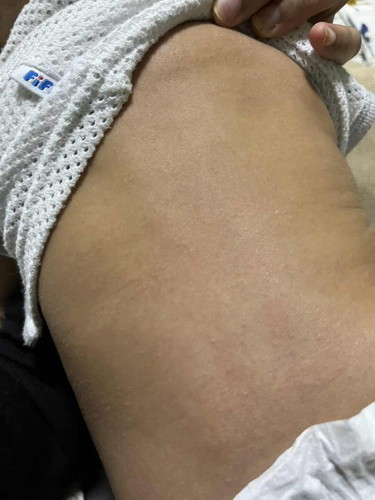 Ini apa ya naik biji2 belakang badan baby