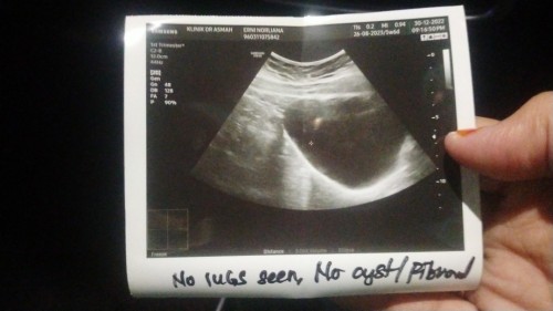 Normal ke UPT (-VE) & SCAN KANTUNG TAK NAMPAK TAPI PREGNANT?