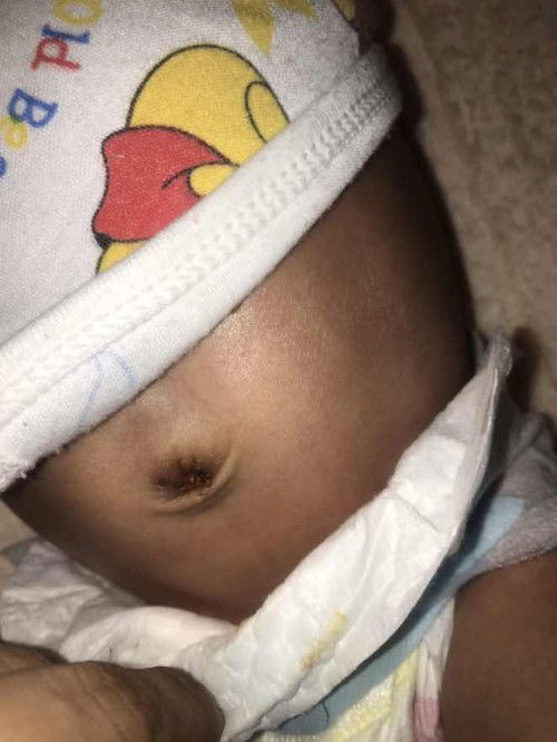 สะดือลูกเป็นแบบนี้ควรทำไงดีคะ