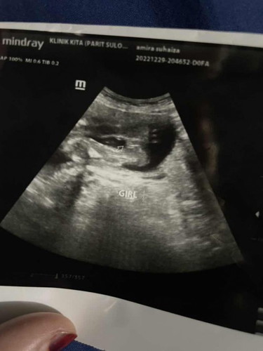 Scan baby perempuan atau lelaki