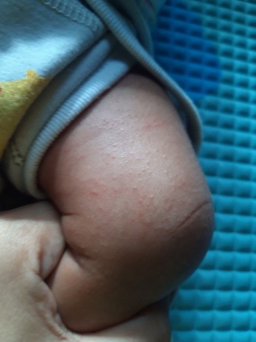 Bintik merah pada bayi