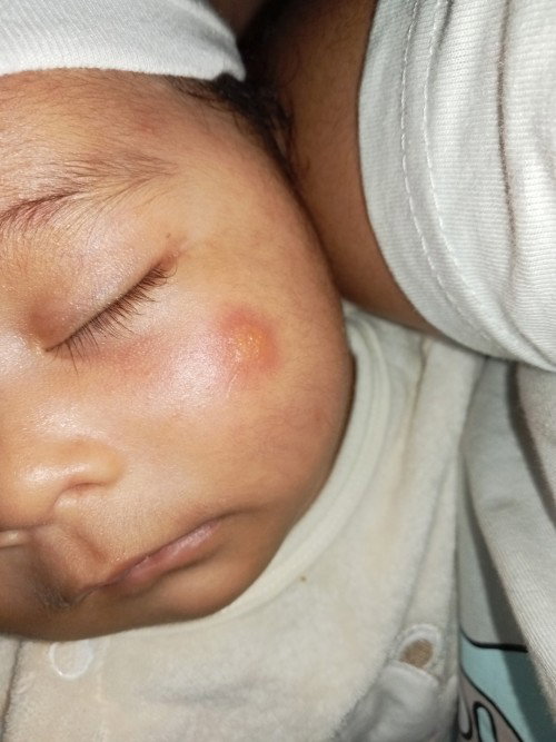 Insect Bites