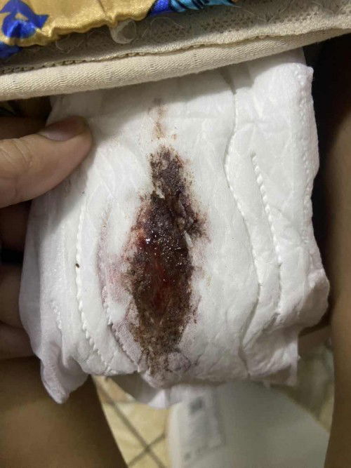 เลือดออกทางช่องคลอด