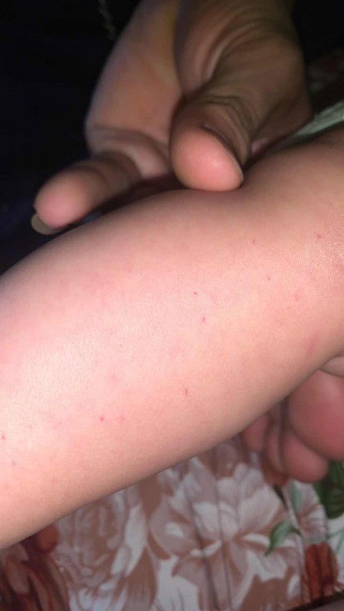 Bintik bintik di kaki