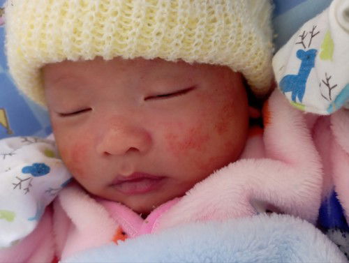 หน้าน้องเป็นผื่น