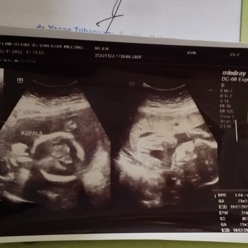 Kira2 bakalan.berubah engga yq bun jenis kelamin ya , aku usg katanya cwe