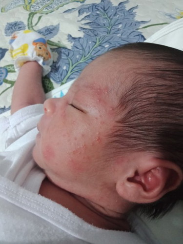 Baby Acne or Rashes?