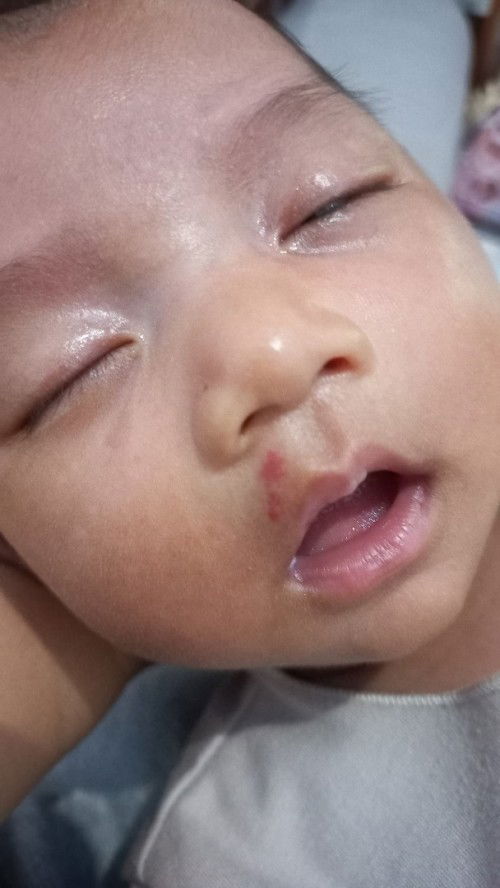 Merah2 ga mau hilang, bukan ruam