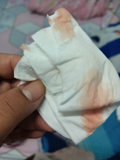 แบบนี้เรียกมูกเลือดมั้ยค่ะ