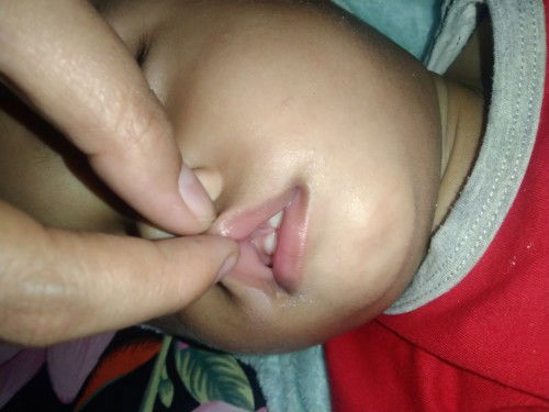 Bun ini toungue lip tie bukan?