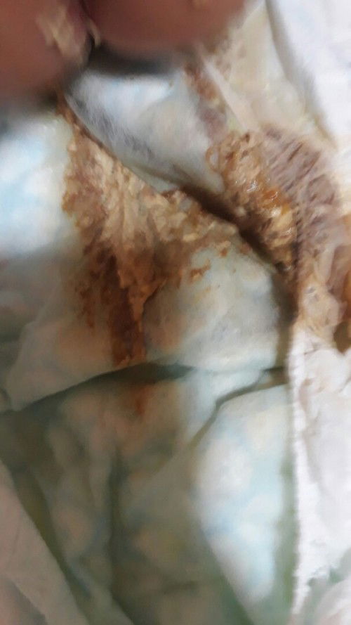 mga mi normal lang ba sa baby na ganito ang poop..bawat dede nia nagpupoop cia ng ganyan