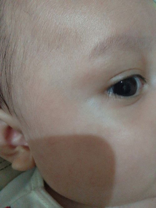 Urat biru di pelipis mata bayi