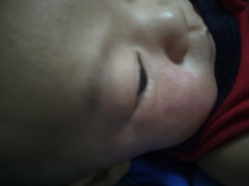 อยากขอข้อมูลจากคุนแม่ๆหน่อยได้ไหมคะ เกี่ยวกับรอยผื่นปื้นแดงตรงบริเวณแก้ม คะ