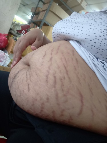 ท้องแตกใครพอแนะนำได้บ้างคะ
