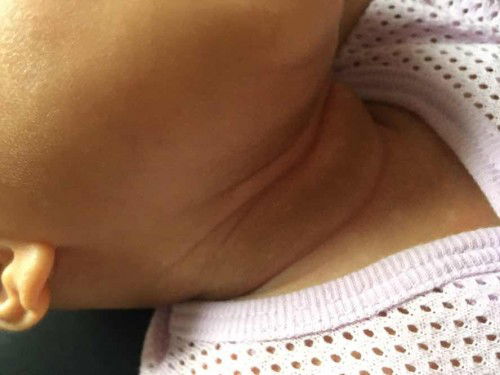 Tompok putih bawah leher