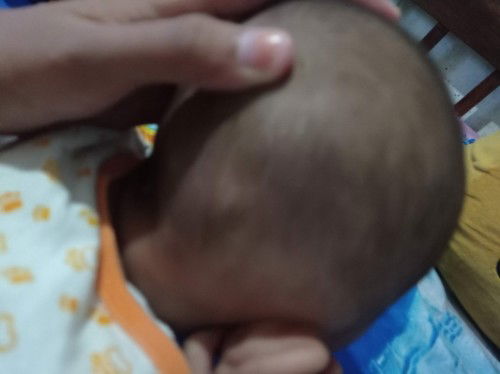 Kepala seperti botak pada bayi 4 bulan