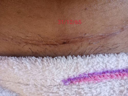 สอบถามเรื่องผ่าซีสที่รังไข่หน่อยคะแม่ๆ