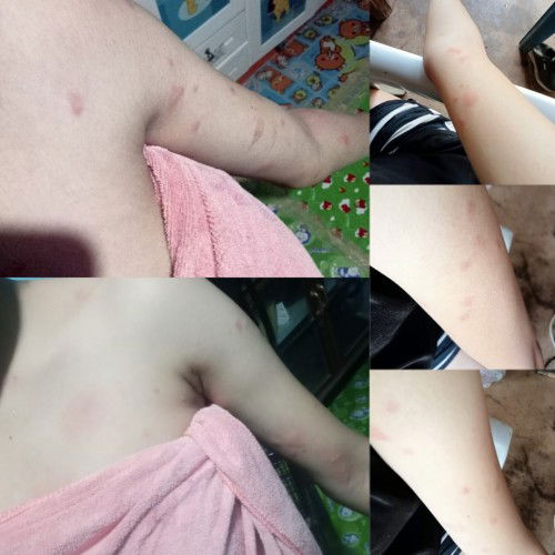 ผื่นขึ้นทั้งตัว